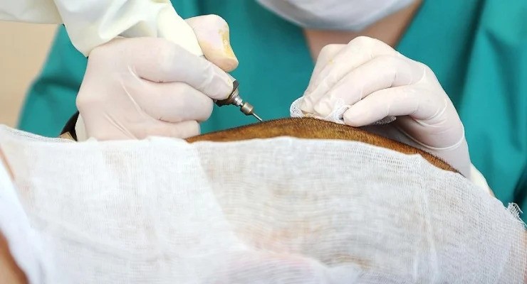 Βρετανός έχασε τη ζωή του στην Κωνσταντινούπολη μετά από μεταμόσχευση μαλλιών